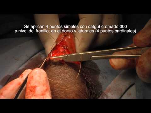 Think, that my adult circumcision much Have my adult circumcision think